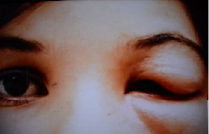Swollen eye